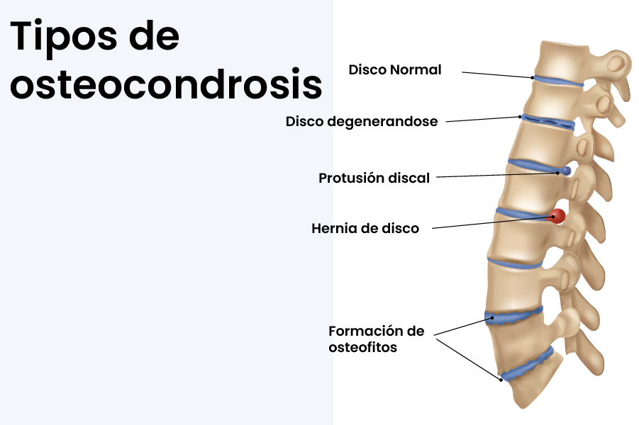 Tipos Osteocondrosis 10
